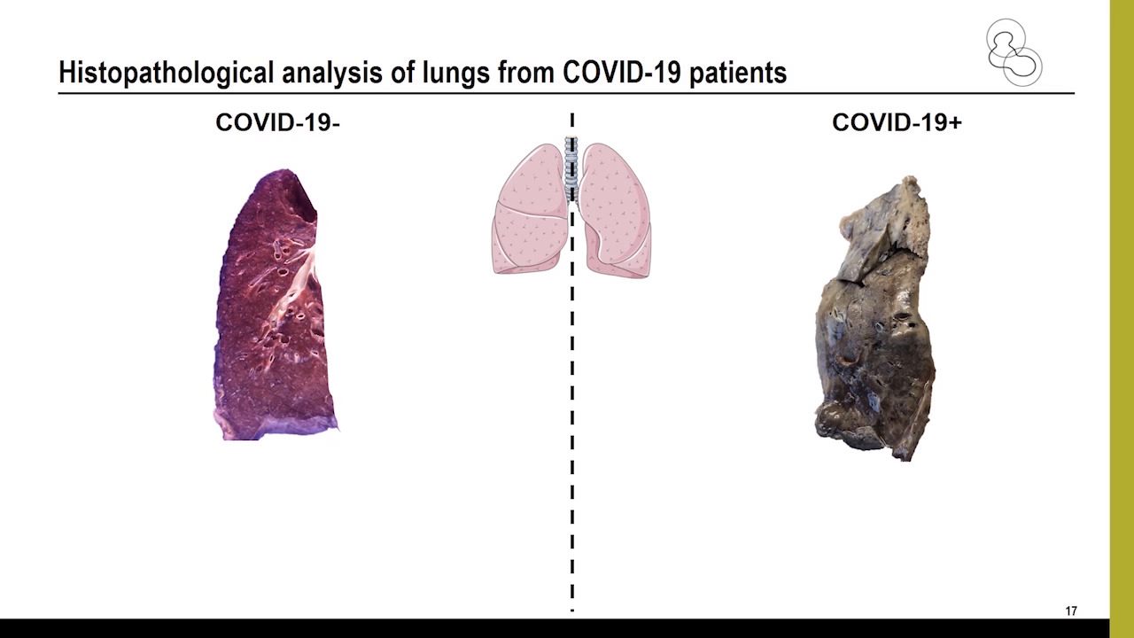 video-association-of-covid-19-inflammation-with-activation-of-the-c5a-c5ar1-axis