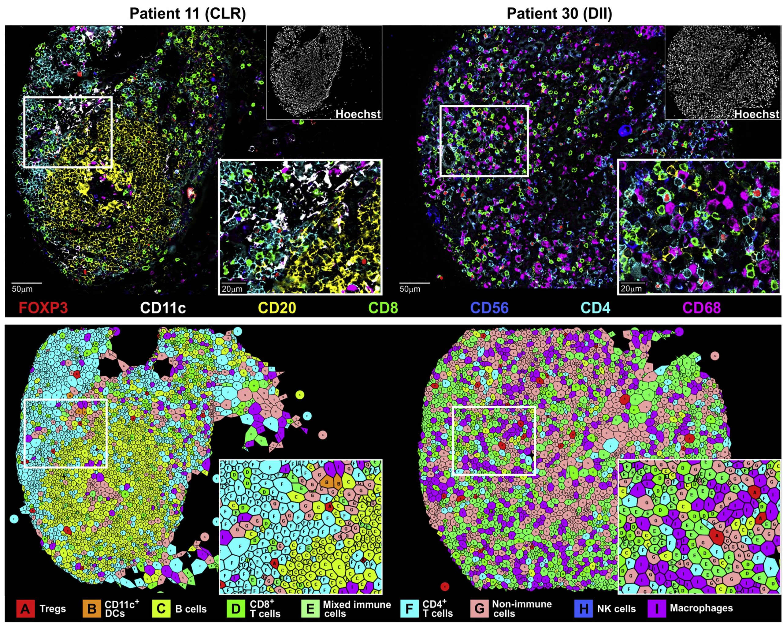 7-color multiplex immunofluorescence images of colorectal cancer from Crohn's like reaction and diffuse inflammatory infiltration patient groups and accompanying voronoi plots.