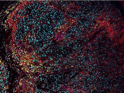 melanoma opal 7 color 1 1