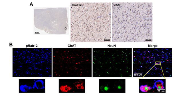 sfn phenocycler parkinsons