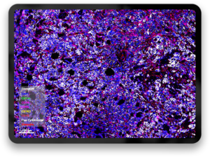 data squamous