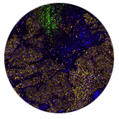 thumbnail LungCancer