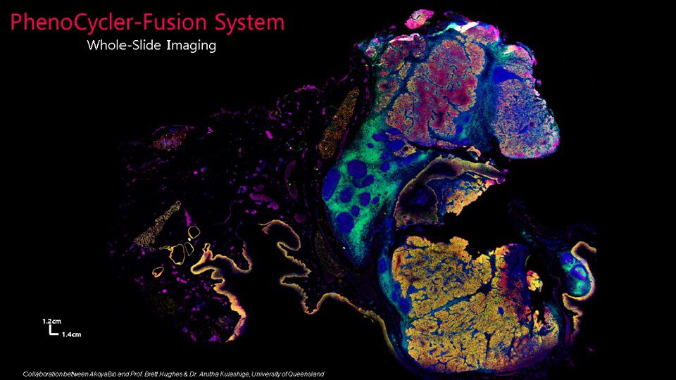 video-understanding-epstein-barr-virus-associated-disease-via-spatial-phenotyping-from-primary-infection-to-malignancy