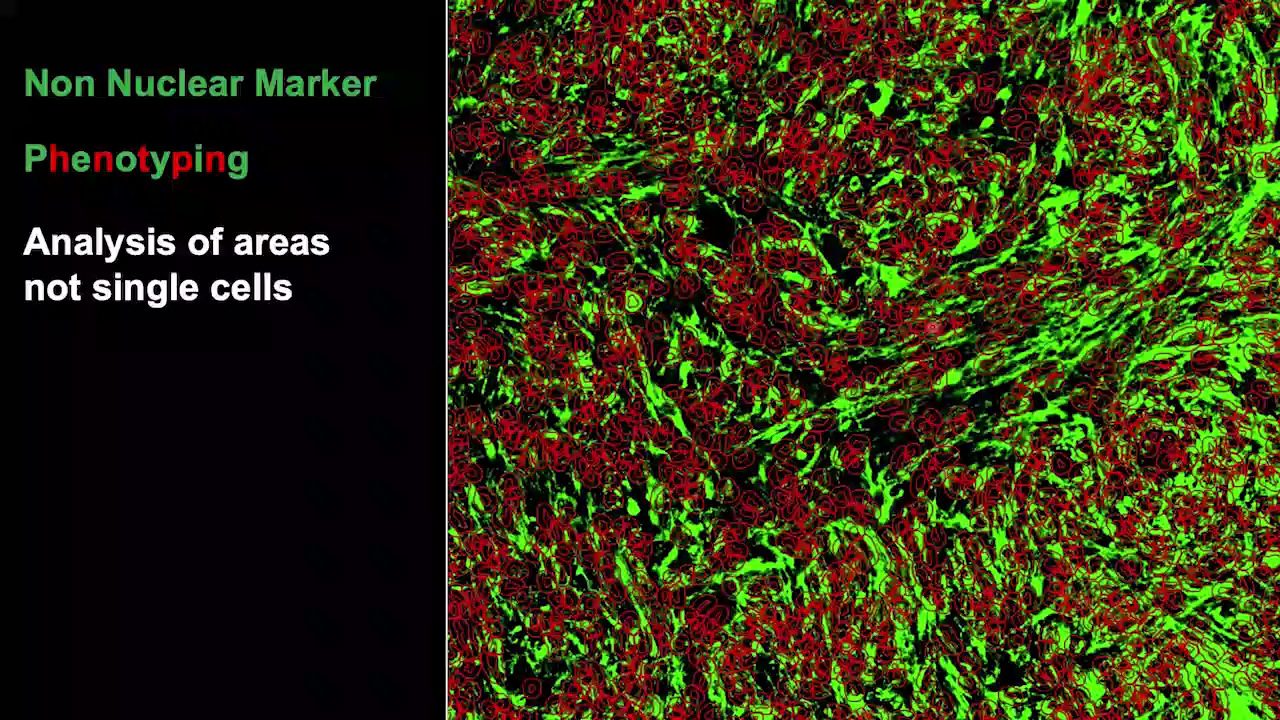 video-deciphering-high-grade-glioma-cellular-hierarchies-and-tumor-architecture-by-multiplex-phenotyping