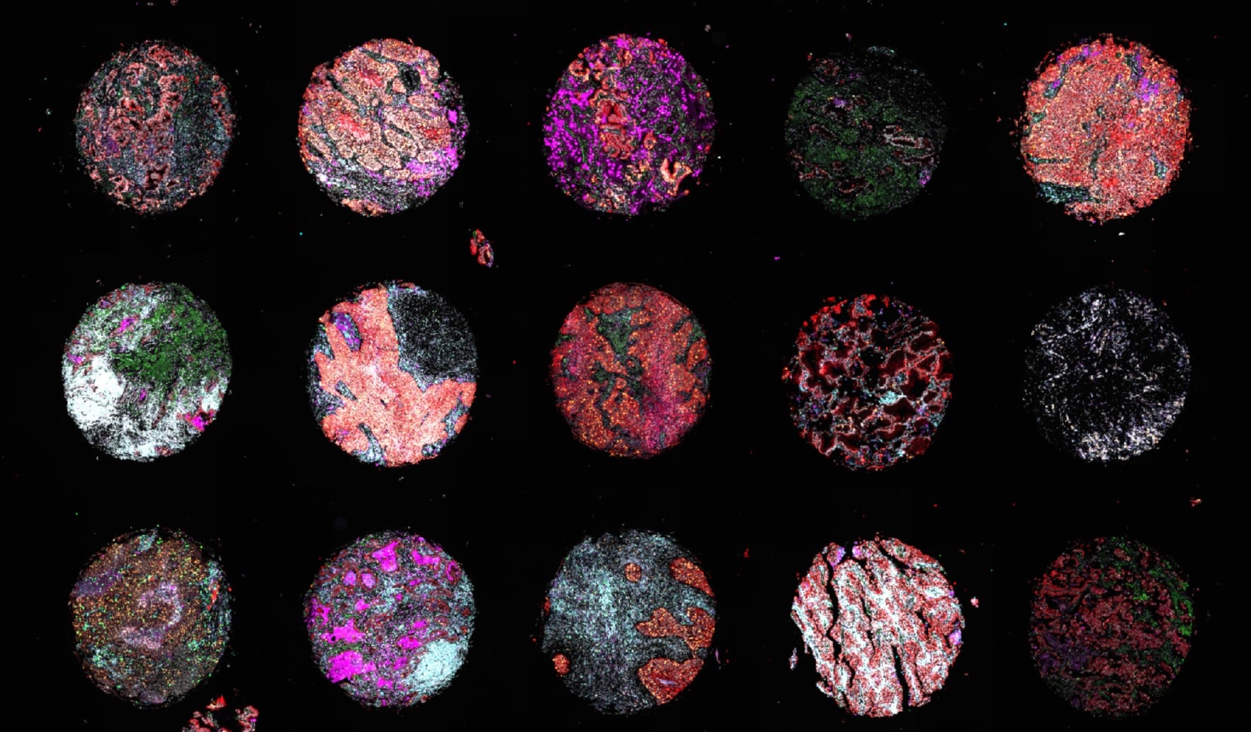 Deciphering Immunotherapy Response in NSCLC with Spatial Biology image