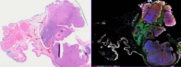 HE vs spatial analysis of cancer tissue sample