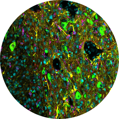 Ultrahigh plex Glioblastoma