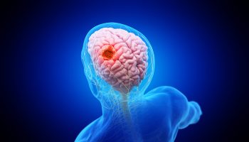 Akoya-Cancer-Cell-Giloma-Blog-Post-1000px