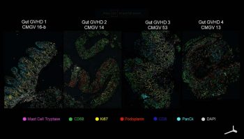 Gut-GvHD-progression-CODEX-@2x