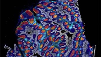 pcf-dataset-tonsil-image