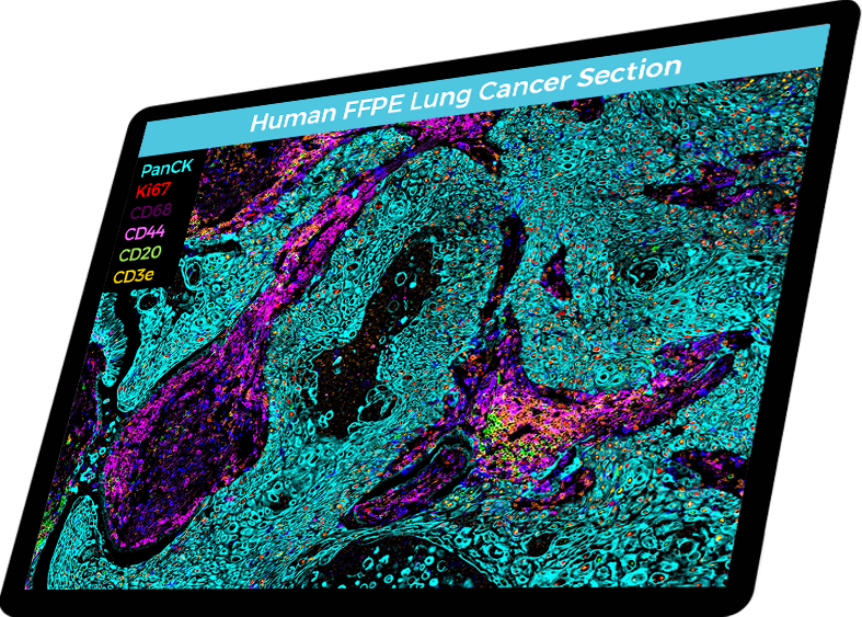 lung cancer markers